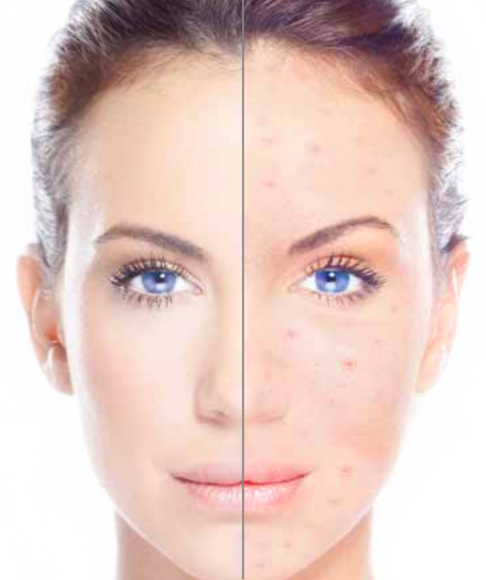 Acne Background Isolated PNG