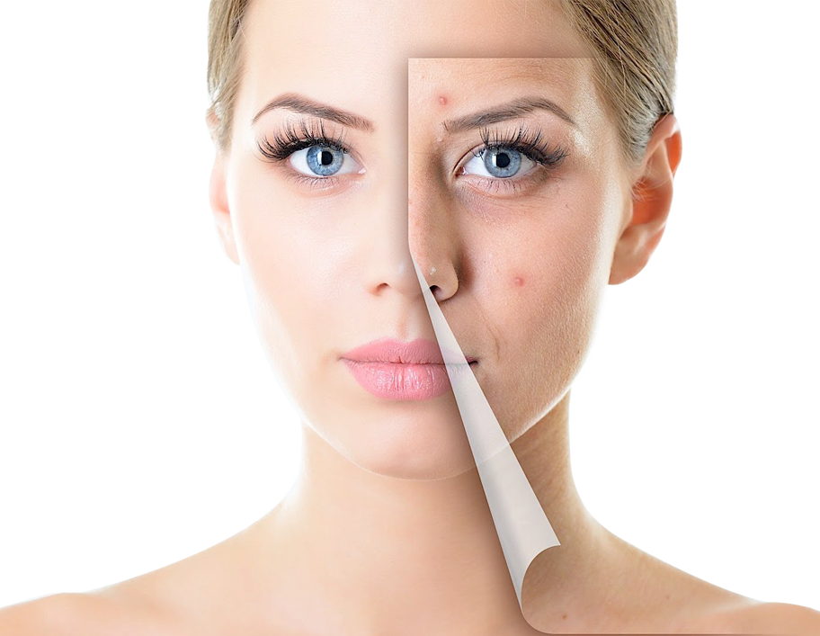 Acne Download PNG Image