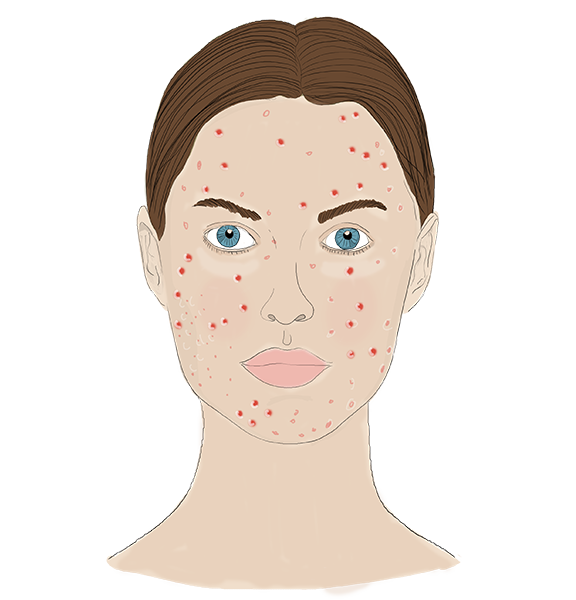 Acne PNG free Download