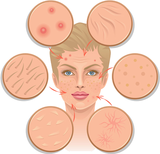 Acne PNG Image
