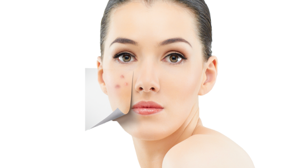 Acne PNG Isolated HD