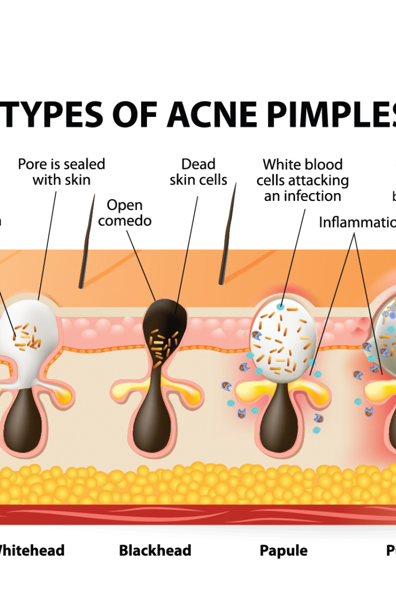 Acne PNG Isolated Pic | PNG Mart