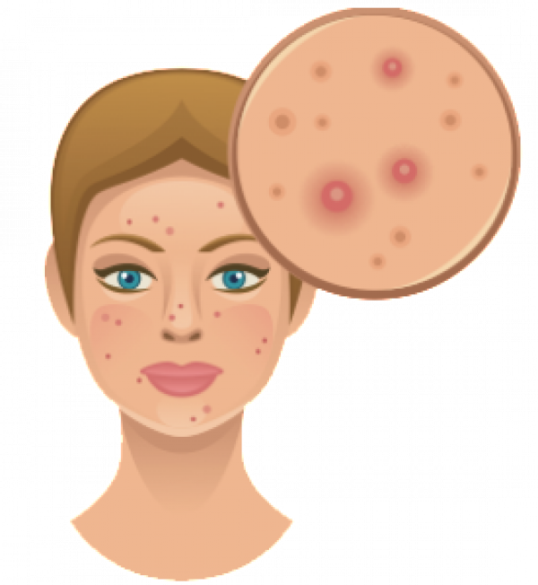 Acne Vector PNG