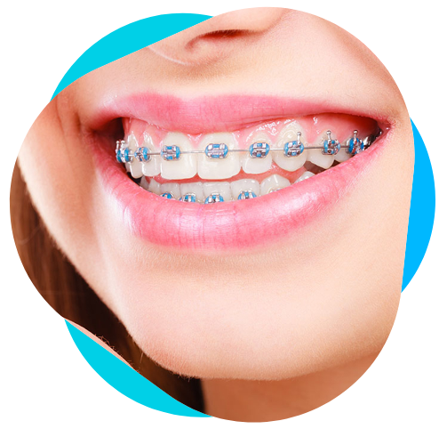 Braces PNG Isolated Pic