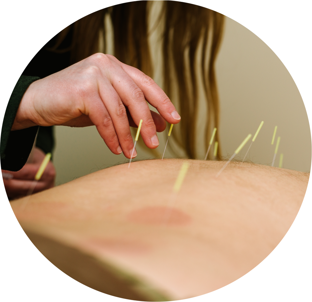 Acupuncture PNG Image